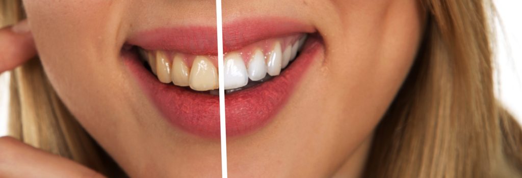 Des dents blanches, les conseils de Yann Guez