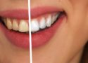 Des dents blanches, les conseils de Yann Guez