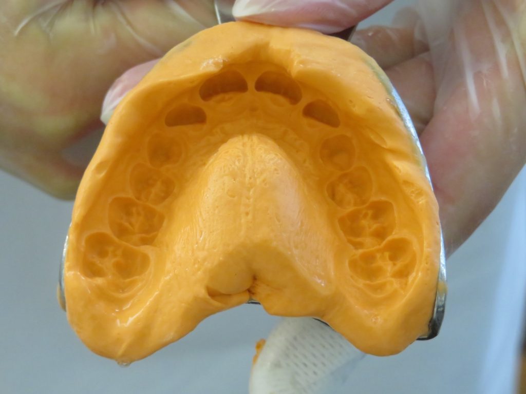 Invisalign, méthode efficace