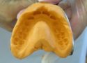 Invisalign, méthode efficace