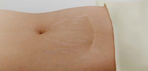 Traiter vergetures laser