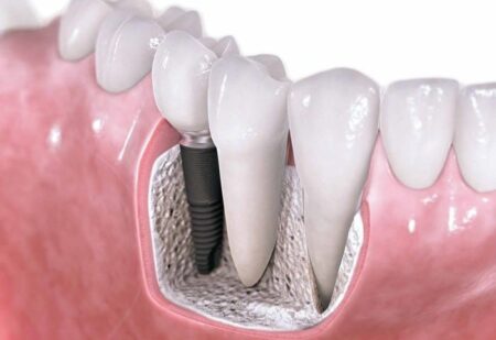 implants dentaires en Hongrie