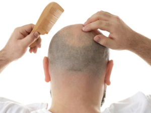 Qu'est-ce que la perte de cheveux ?