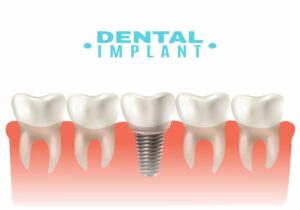 implant dentaire Hongrie