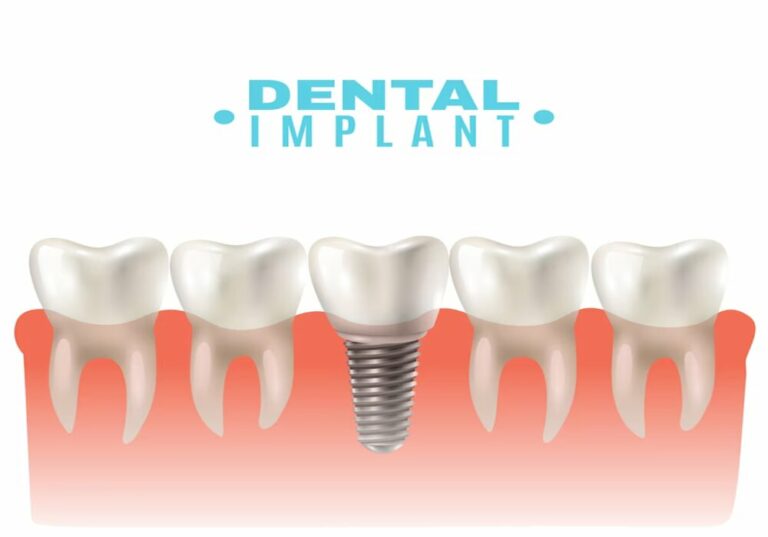 implant dentaire Hongrie