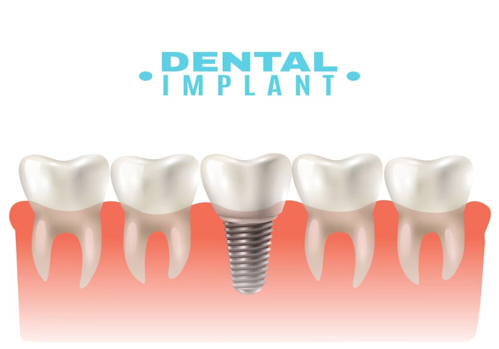 implant dentaire Hongrie