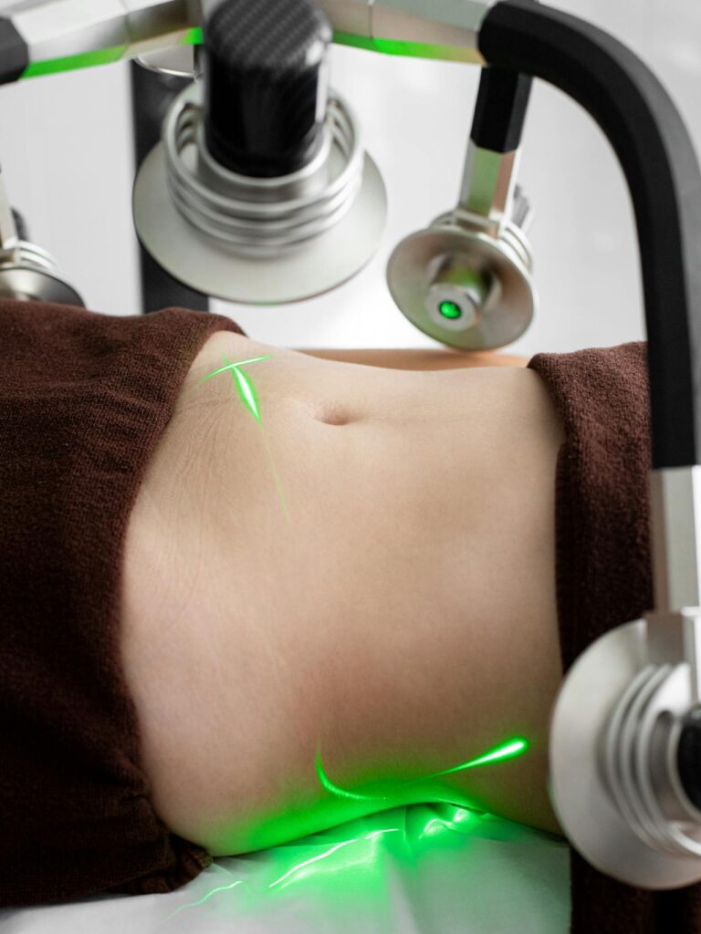 Liposuccion : éliminer les graisses tenaces et sculpter la silhouette efficacement